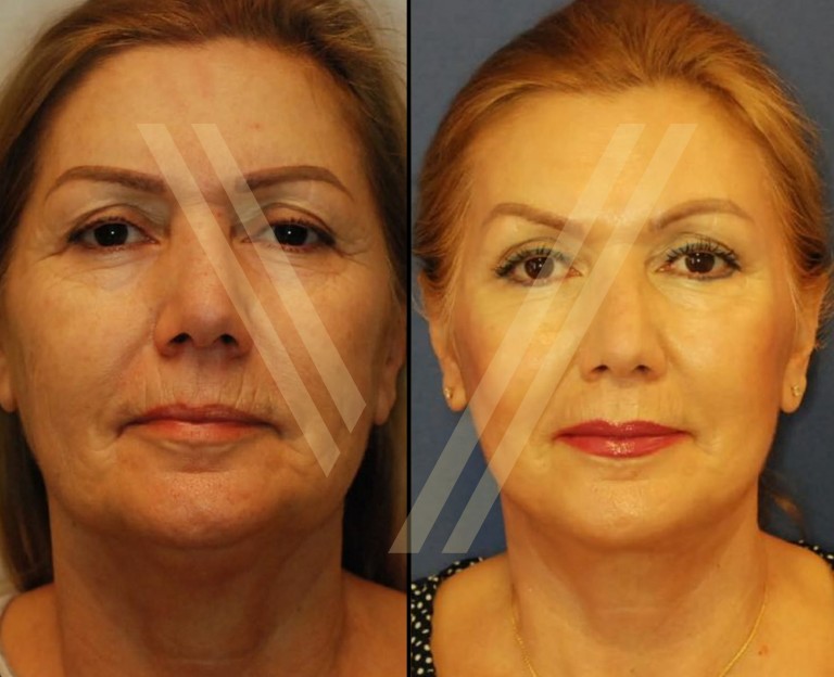 facelift before and after vantage cosmetic clinic results