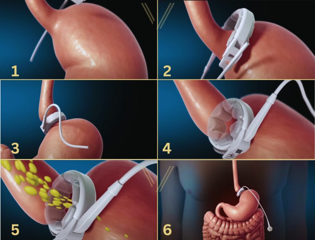 Gastric Band Surgery Procedure Step by step