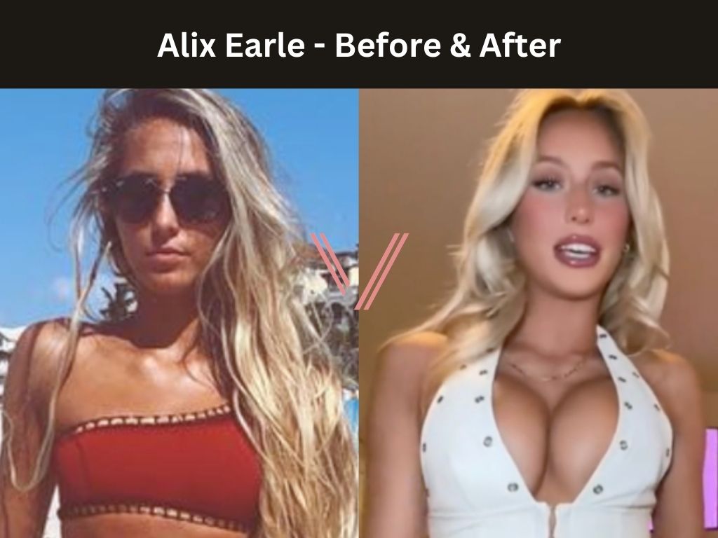 Alix Earle - Breast Implant Before and After