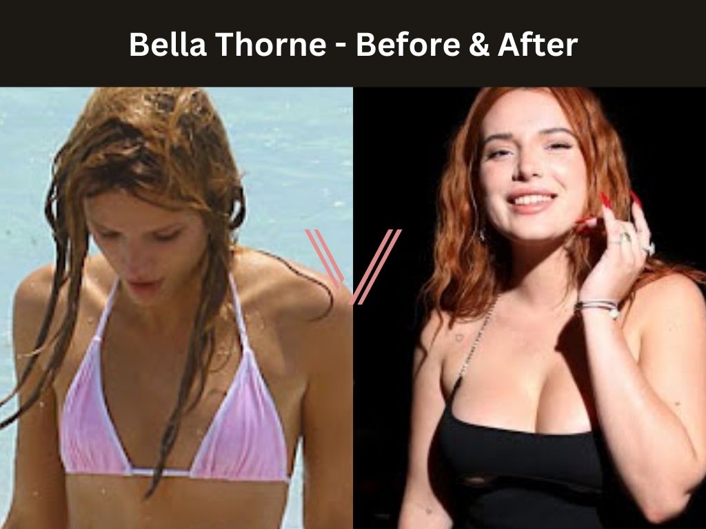 Bella Thorne - Breast Implant Before and After
