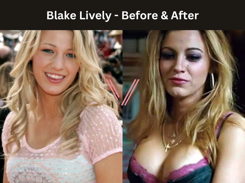 Blake Lively Breast Implant Before and After