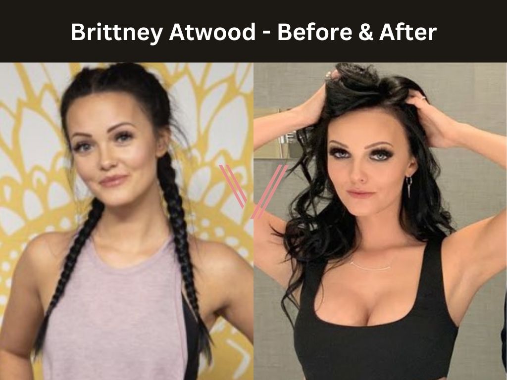 Brittney Atwood- Breast Implant Before and After