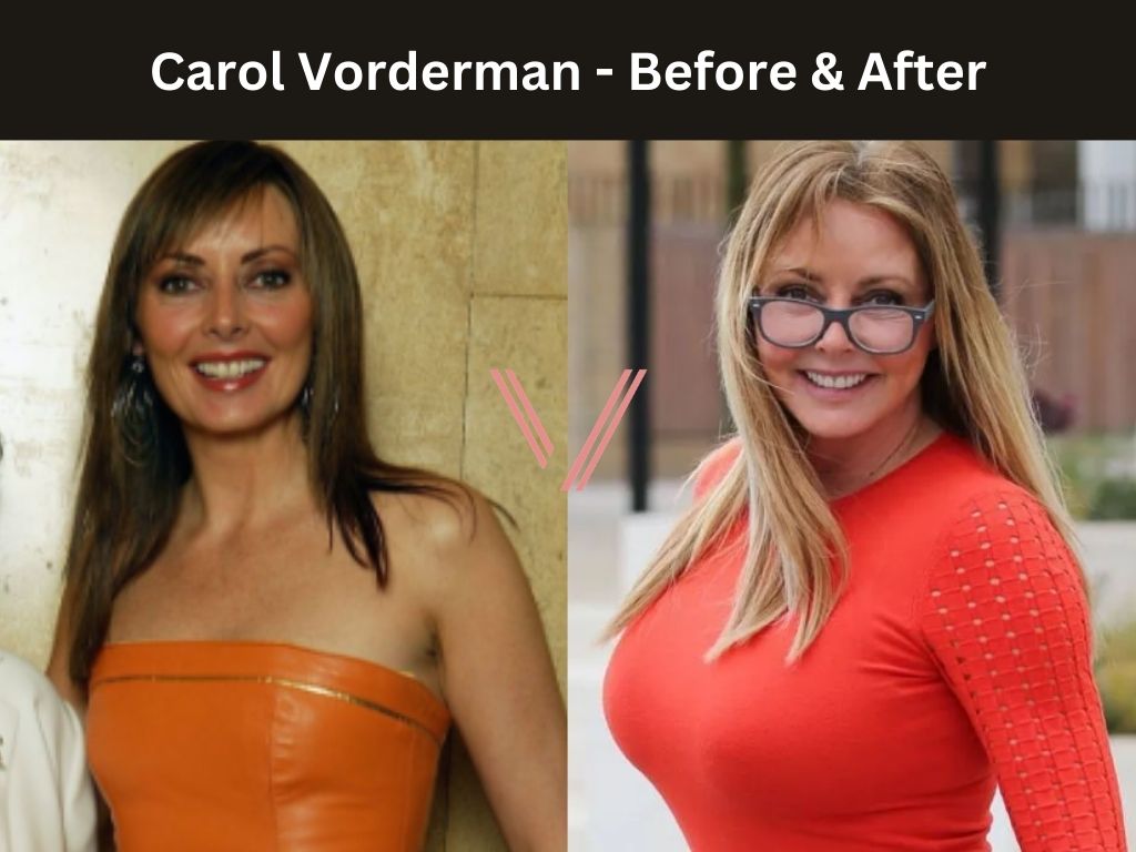 Carol Vorderman Breast Implant Before and After