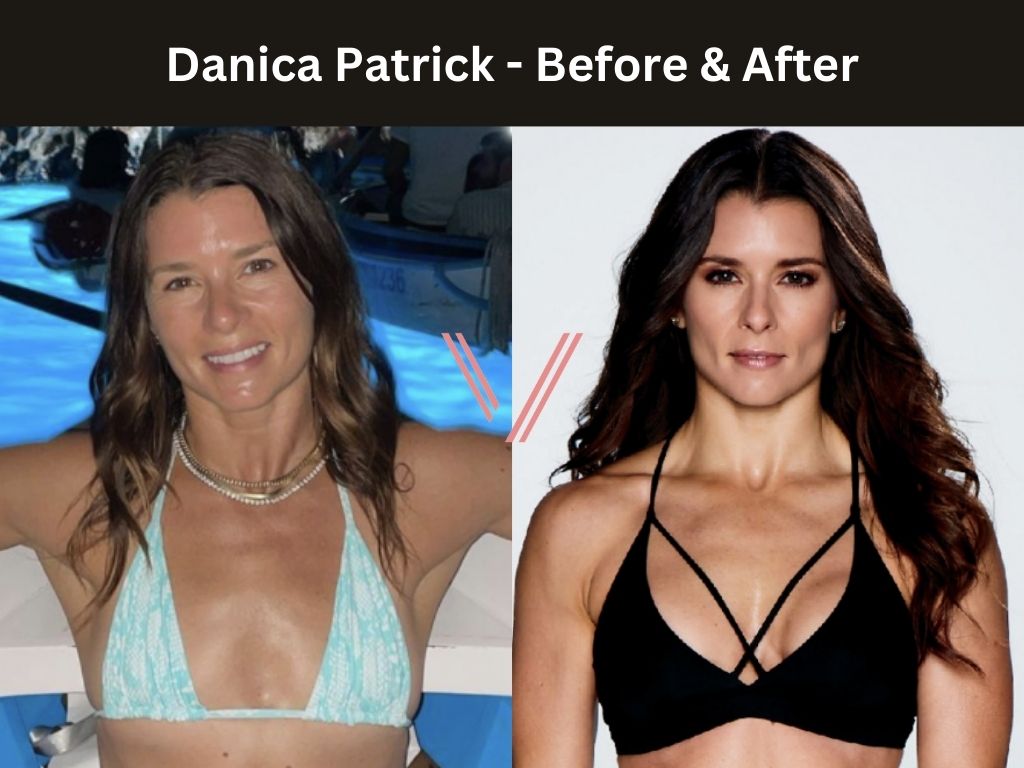Danica Patric - Breast Implant Before and After
