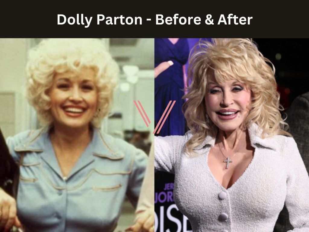 Dolly Parton - Breast Implant Before and After