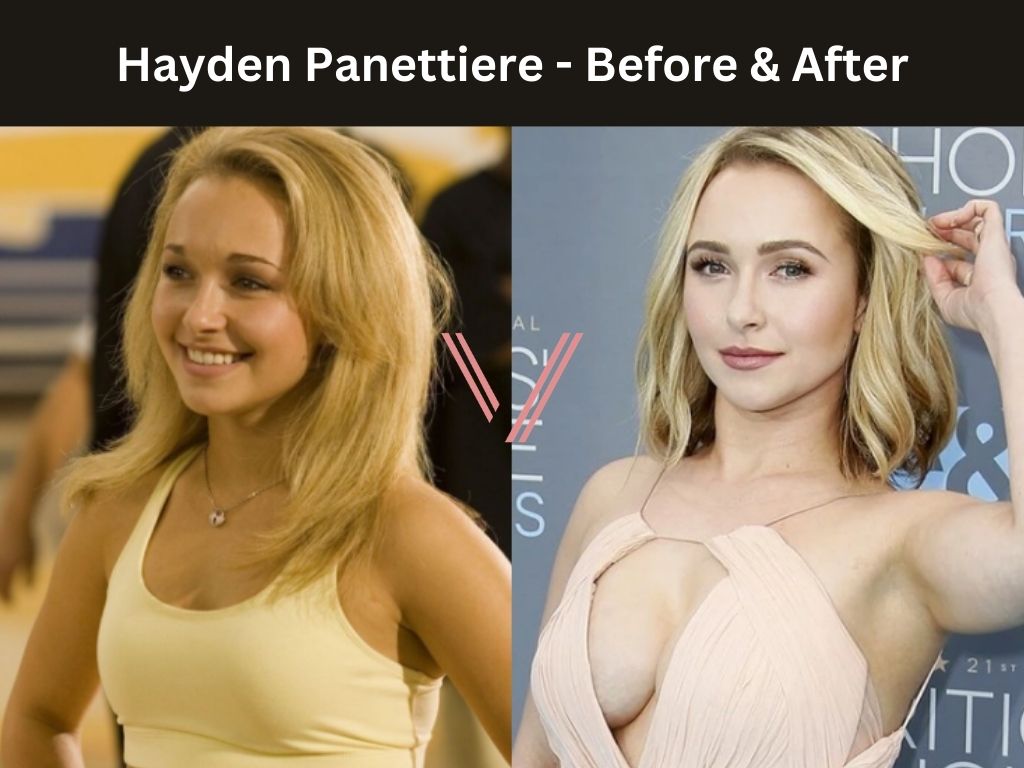 Hayden Panettiere - Breast Implant Before and After