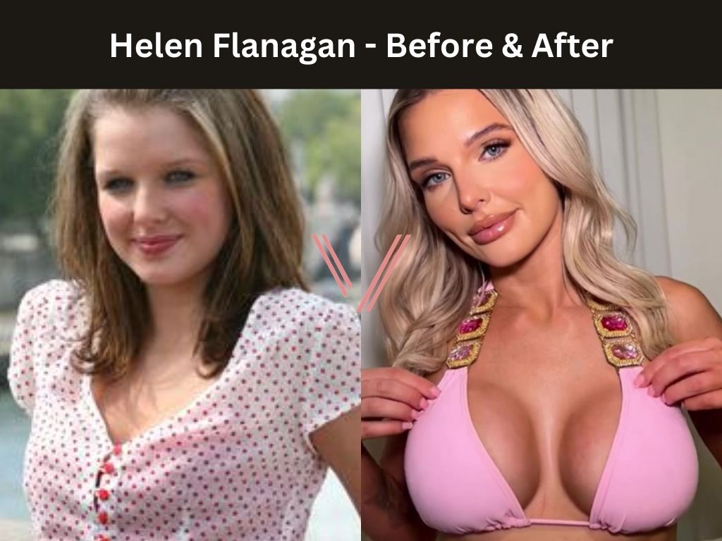 Helen Flanagan - Breast Implant Before and After