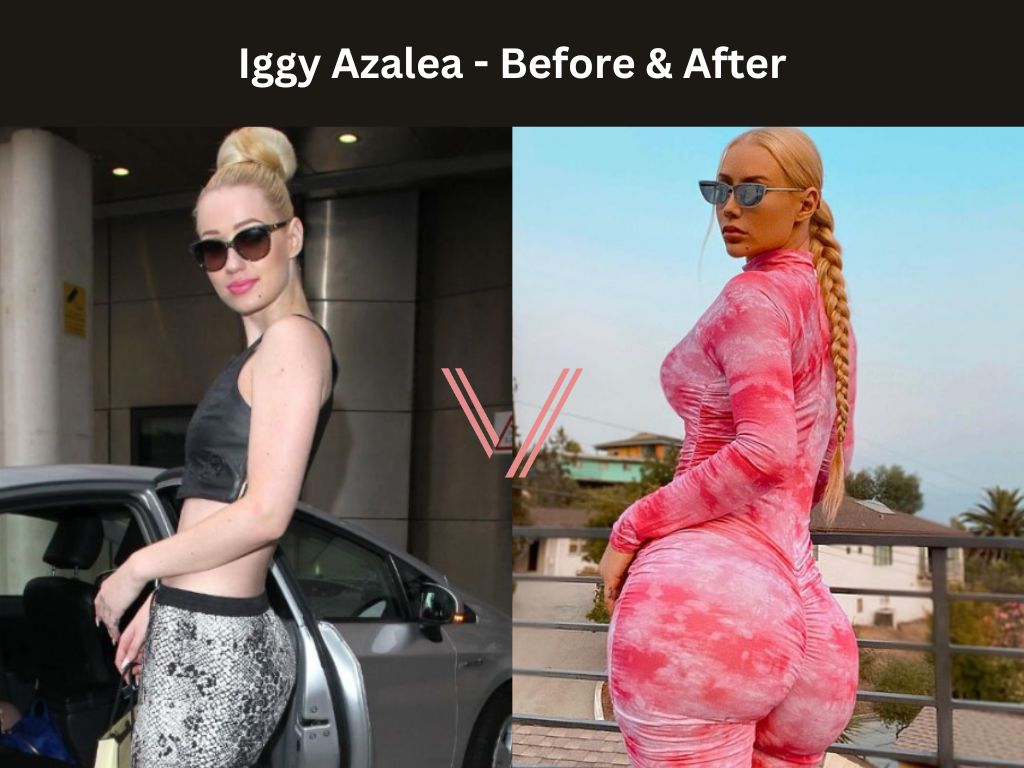 Iggy Azalea BBL Before and After