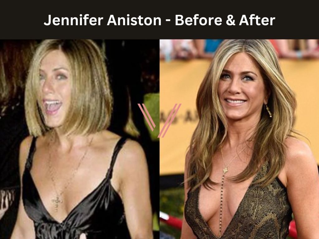 Jennifer Aniston - Breast Implant Before and After