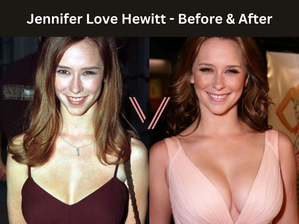 Jennifer Love - Breast Implant Before and After