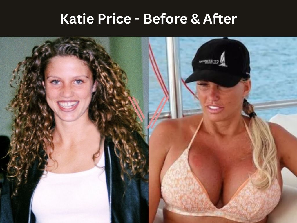 Katie Price - Breast Implant Before and After
