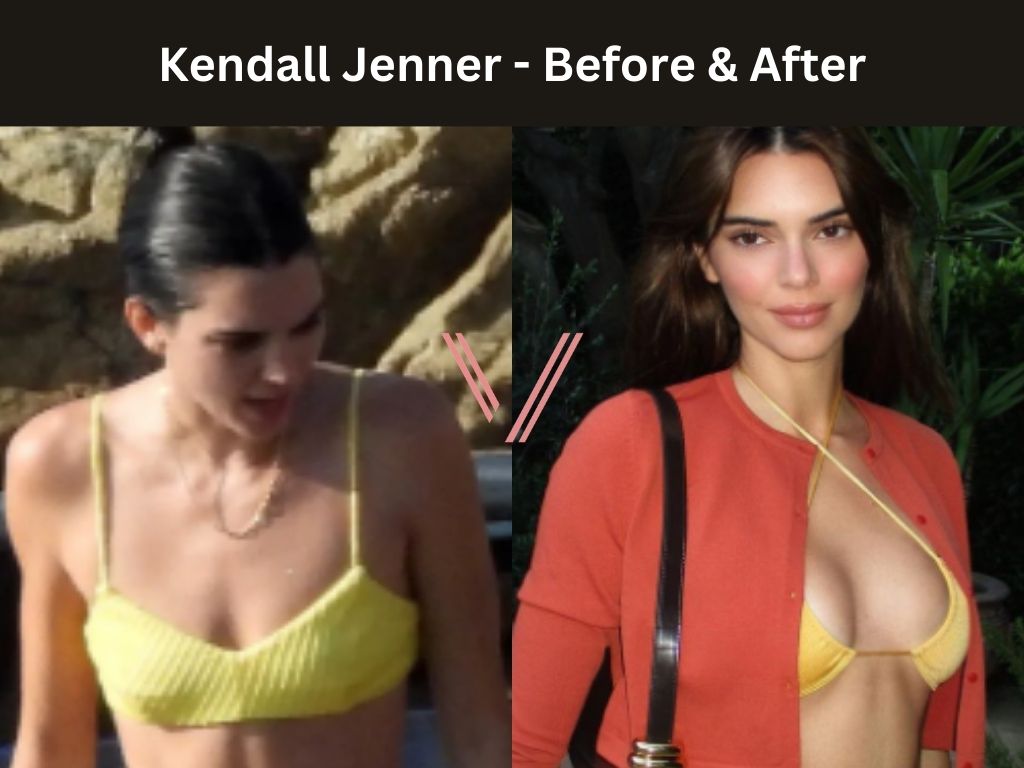 Kendall Jenner - Breast Implant Before and After
