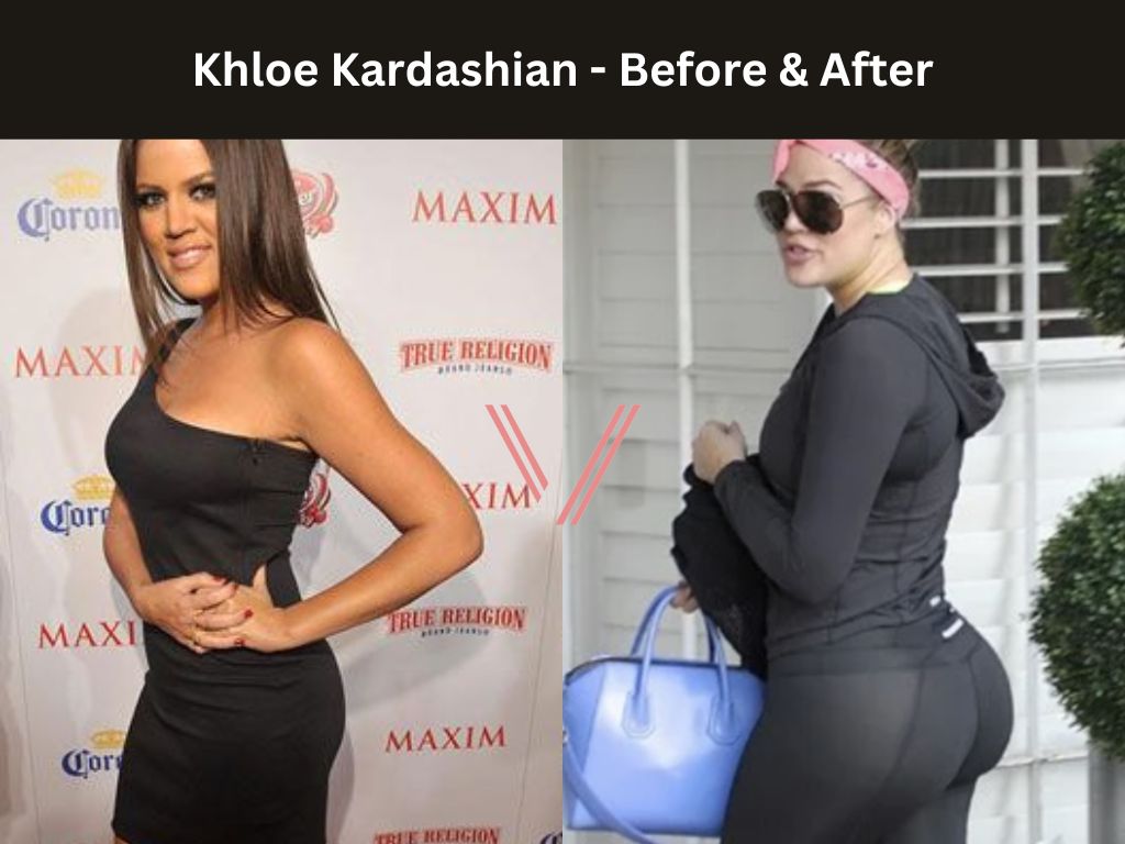 Khloe Kardashian  BBL Before and After