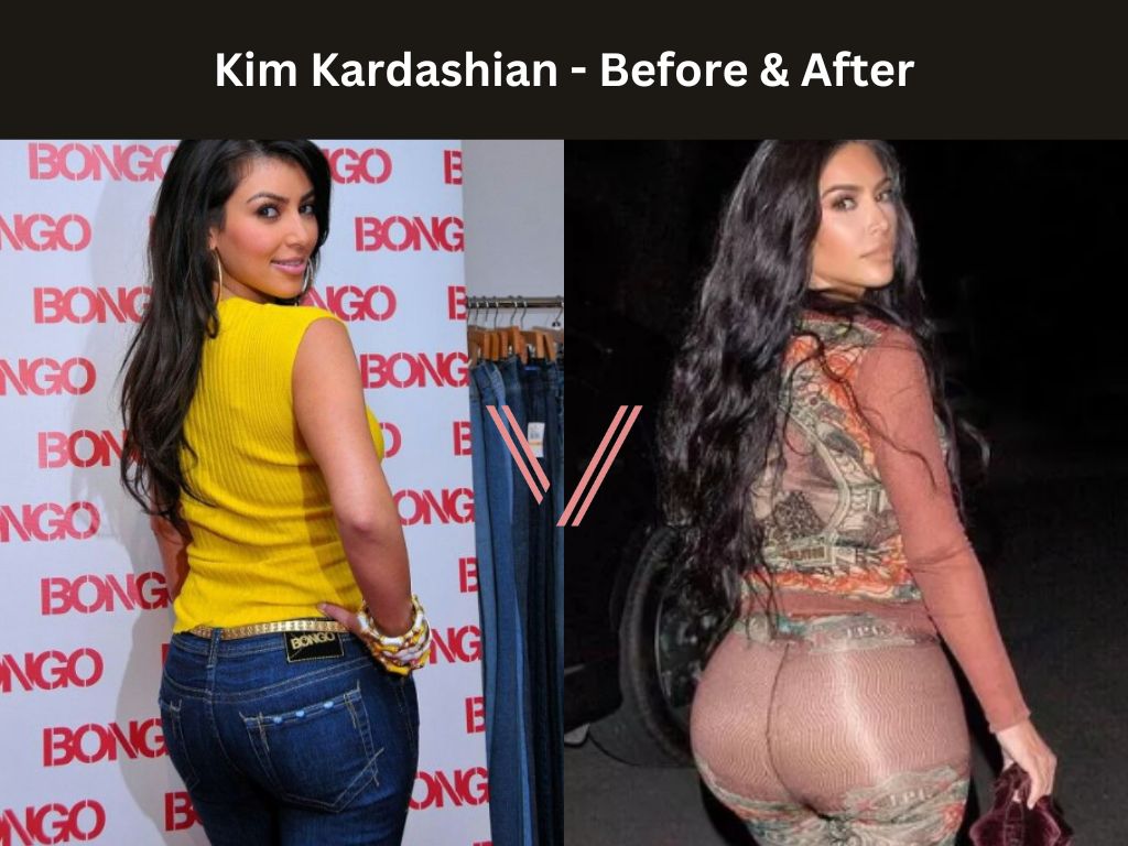 Kim Kardashian BBL Before and After