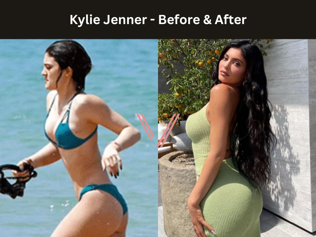 Kylie Jenner BBL Before and After