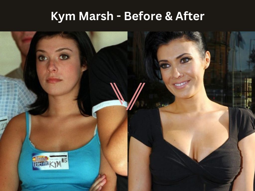 Kym Marsh - Breast Implant Before and After