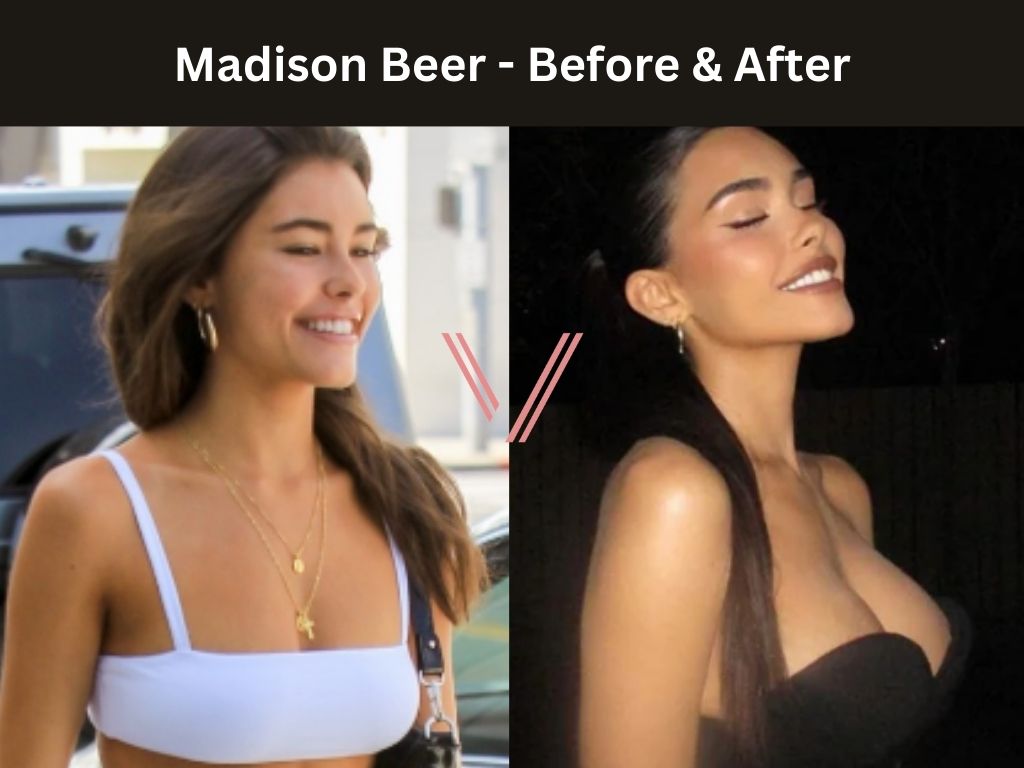 Madison Beer - Breast Implant Before and After