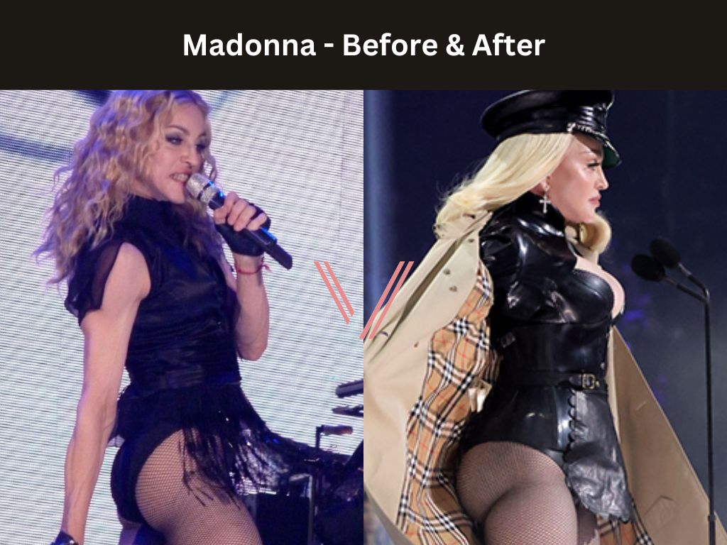 Madonna BBL Before and After