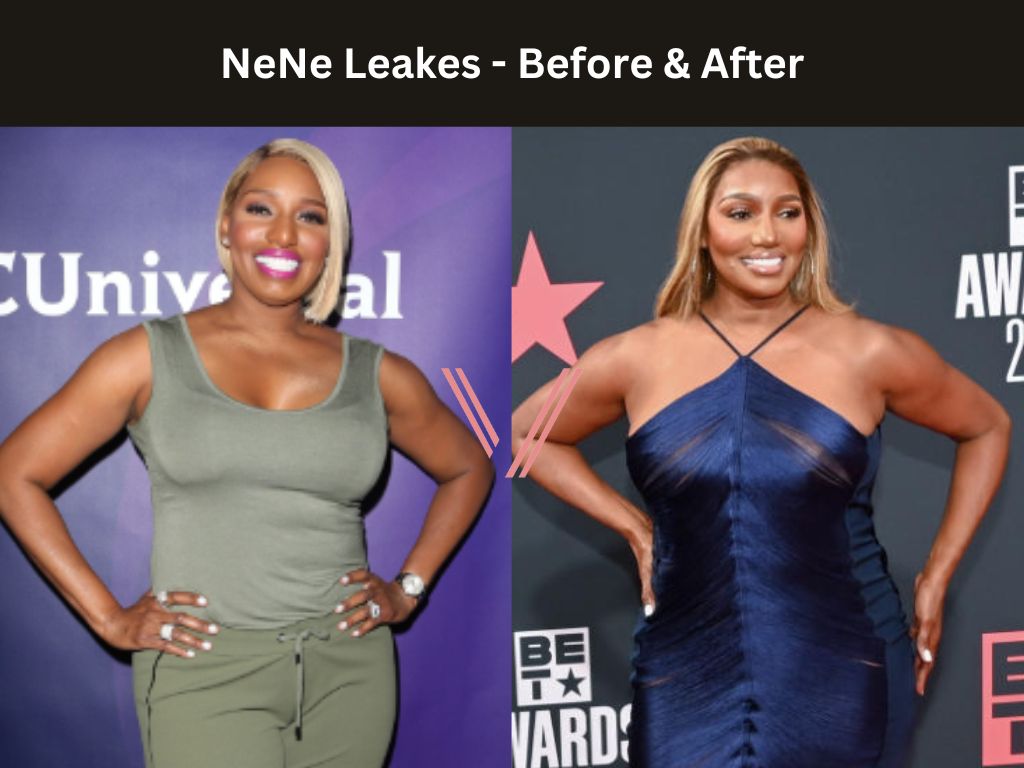 Nene Leakes BBL Before and After