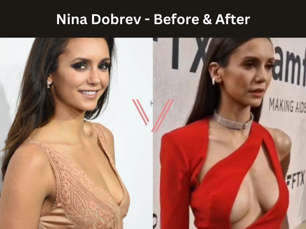 Nina Dobrev - Breast Implant Before and After