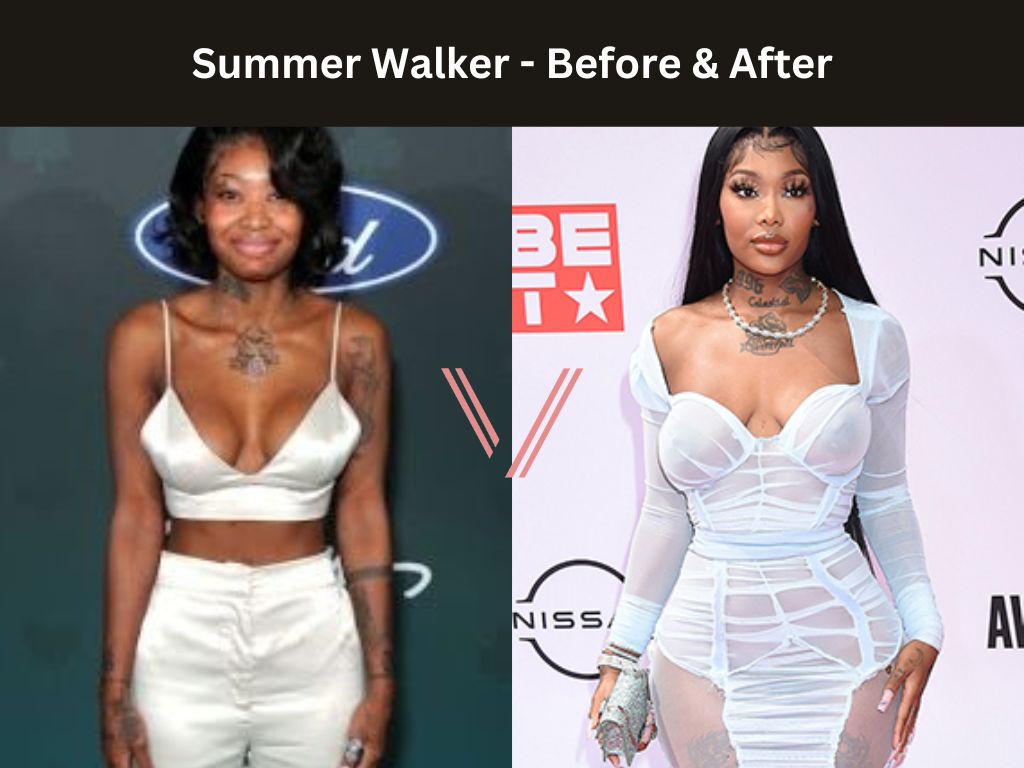 Summer Walker BBL Before and After