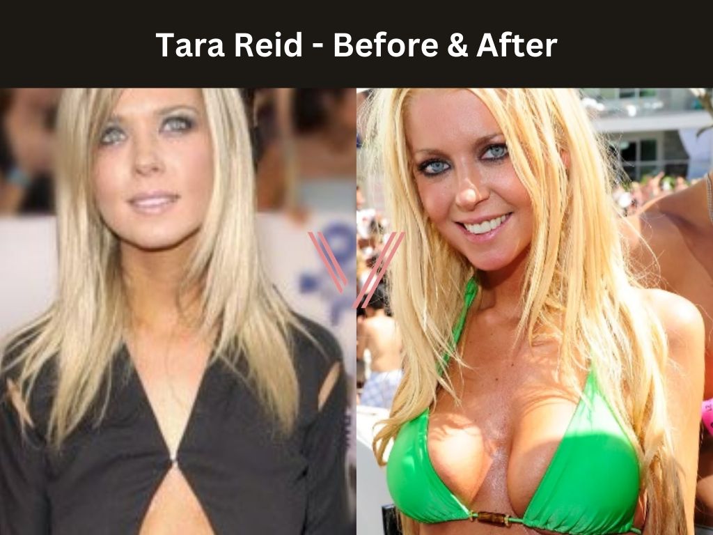 Tara Reid - Breast Implant Before and After