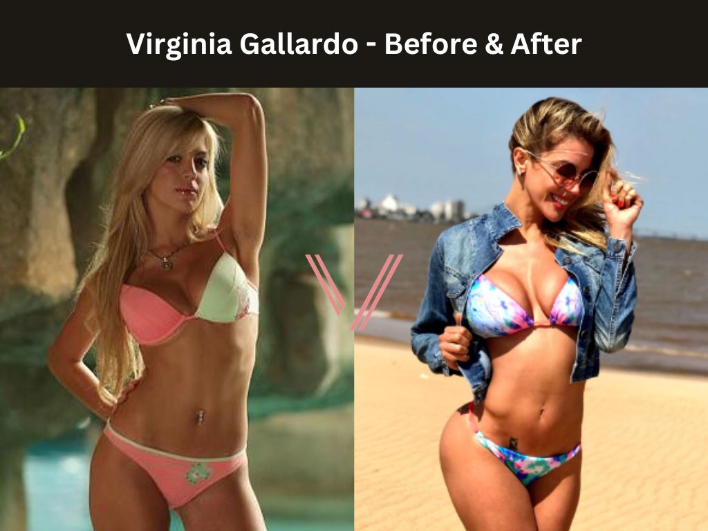 Virginia Gallardo BBL Before and After
