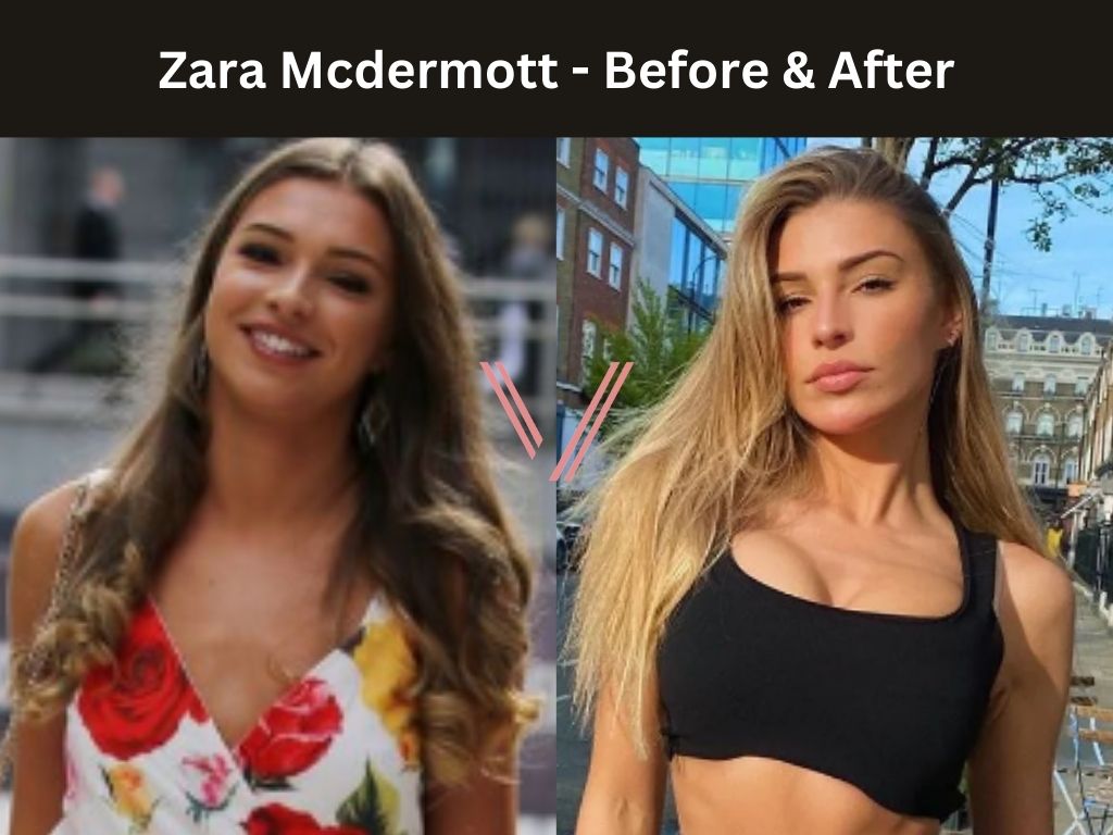 Zara Mcdermott - Breast Implant Before and After