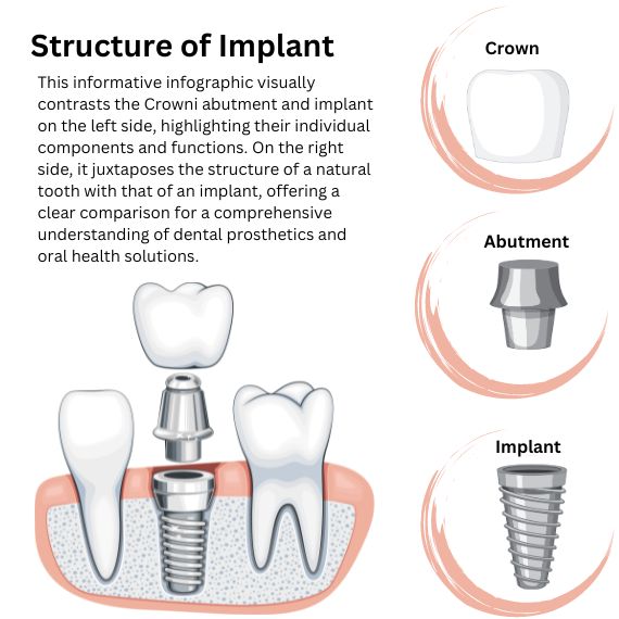 Structure of Implant