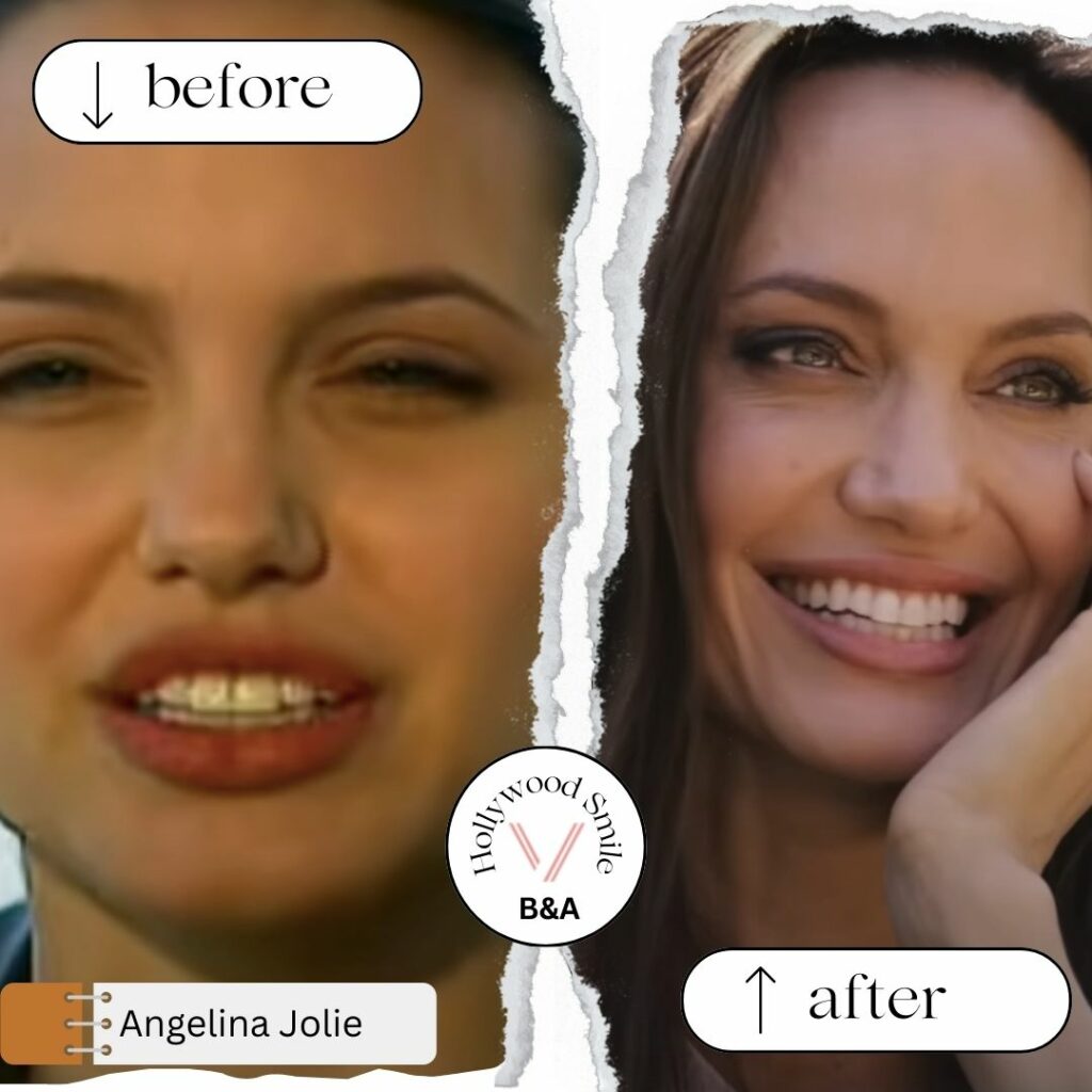 Angelina Jolie Smile Makeovers (Hollywood Smile) Before After