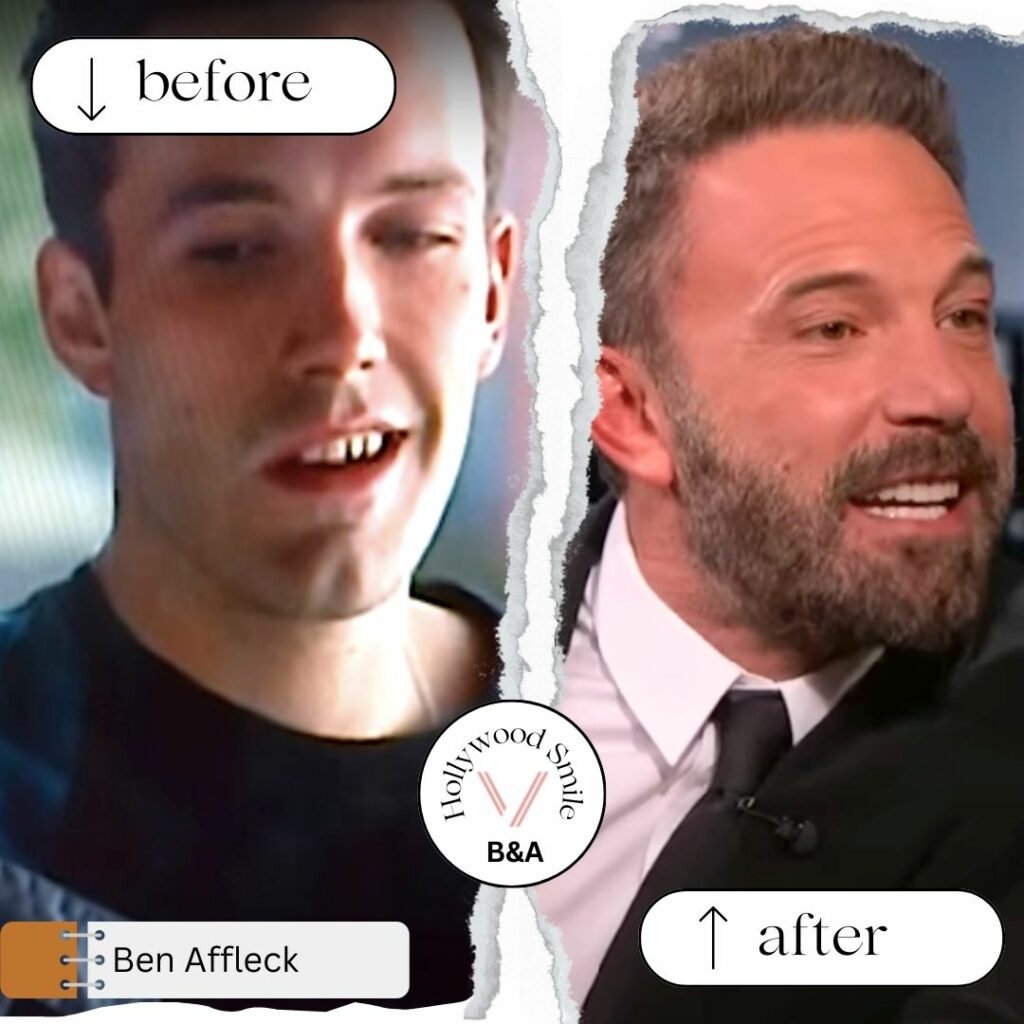Ben Affleck Smile Makeovers (Hollywood Smile) Before After