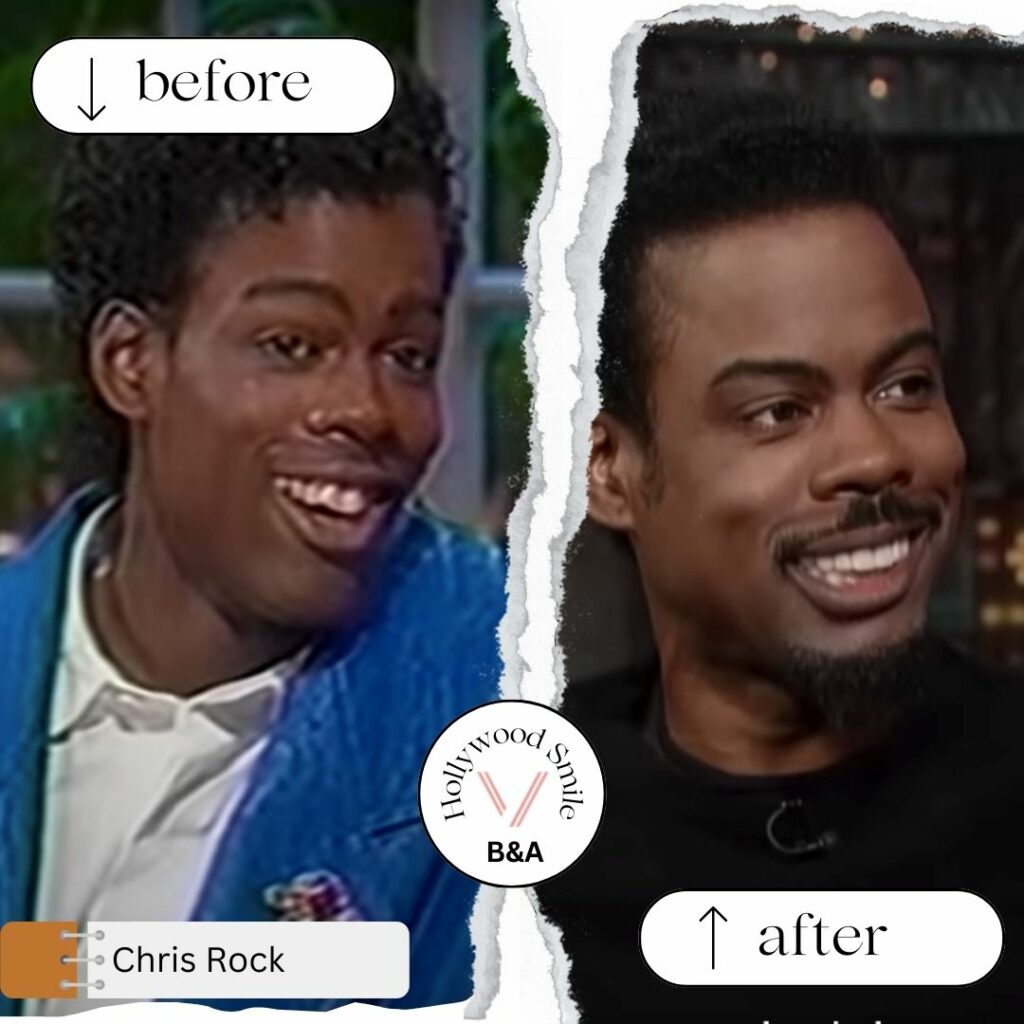Chris Rock Smile Makeovers (Hollywood Smile) Before After
