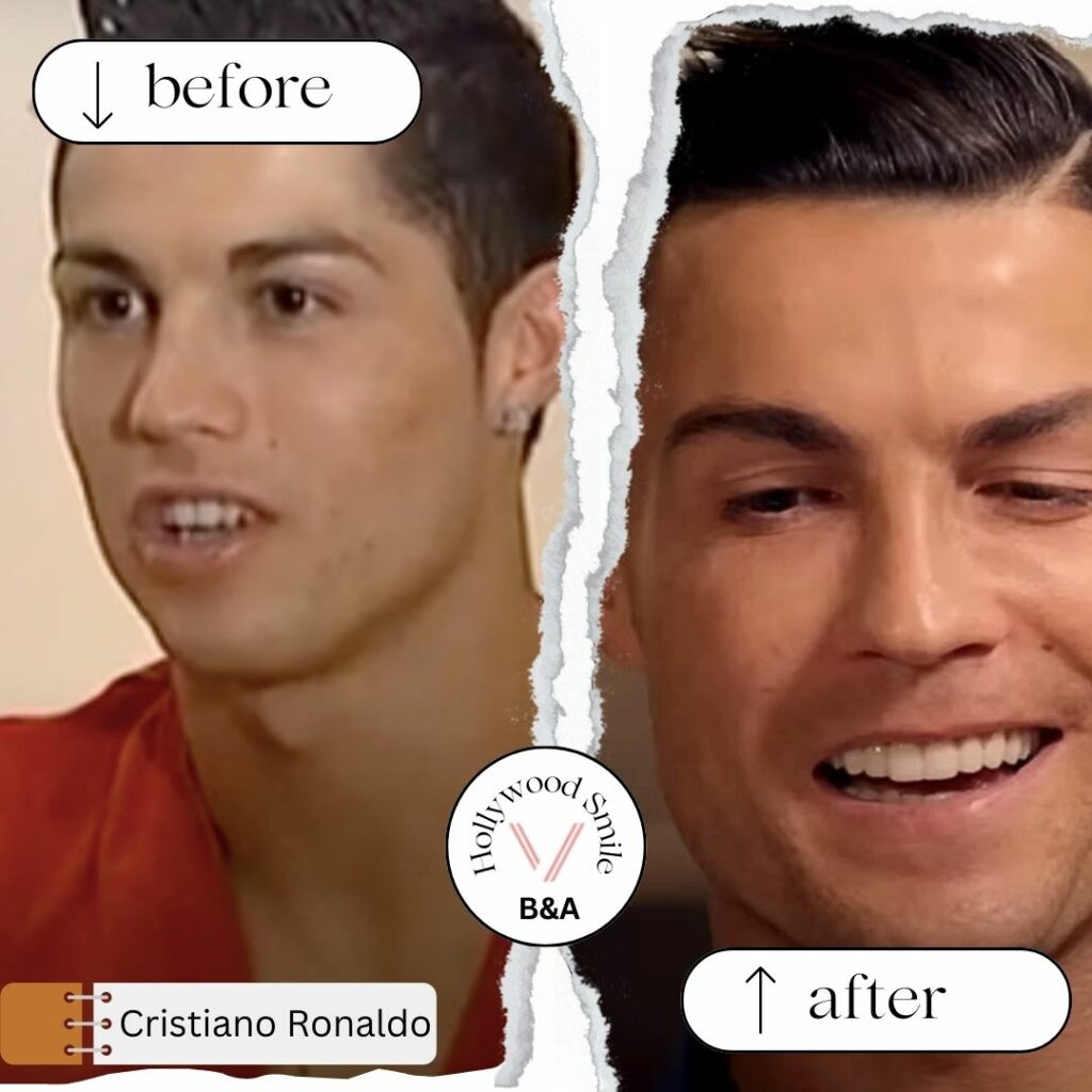 Cristiano Ronaldo Smile Makeovers (Hollywood Smile) Before After
