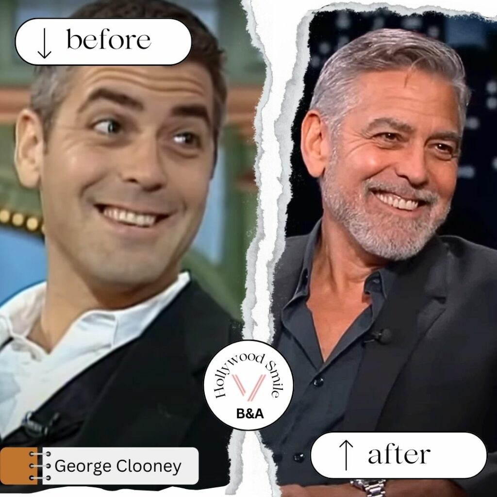 George Clooney Smile Make Overs (Hollywood Smile) Before After​