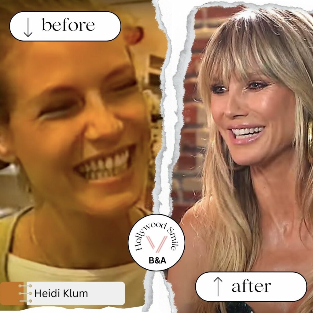 Heidi Klum Smile Makeovers (Hollywood Smile) Before After
