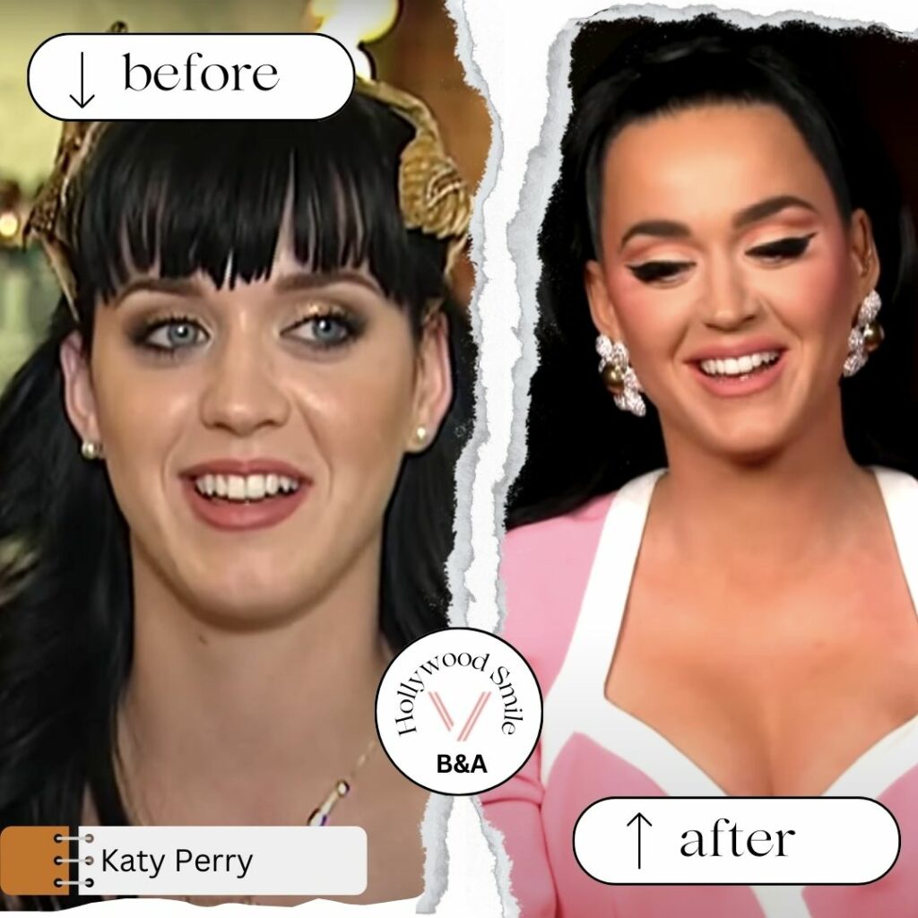 Katy Perry Smile Makeovers (Hollywood Smile) Before After