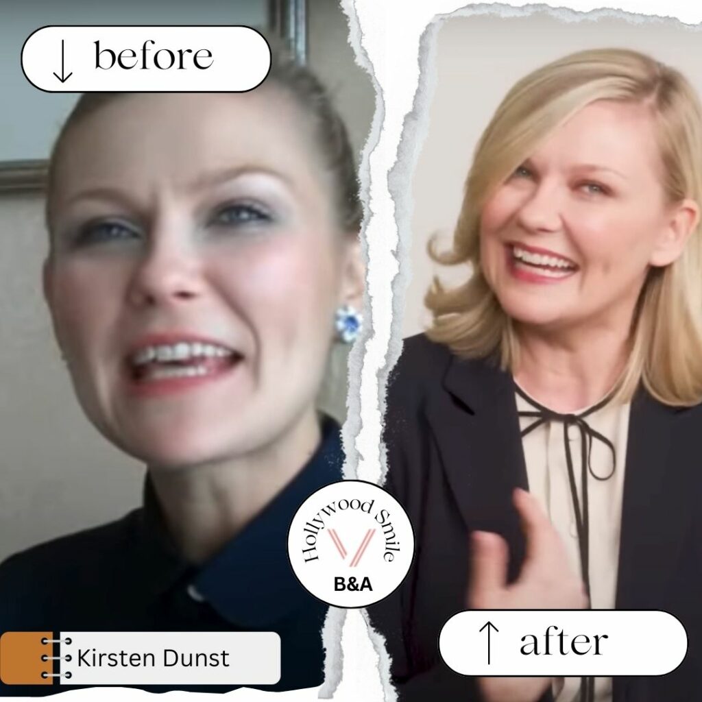 Kirsten Dunst Smile Makeovers (Hollywood Smile) Before After