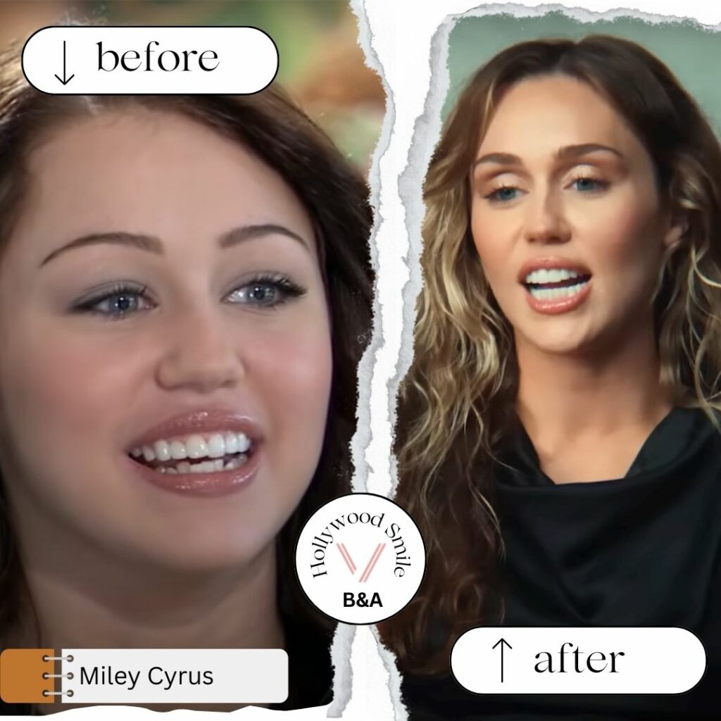Miley Cyrus Smile Makeovers (Hollywood Smile) Before After