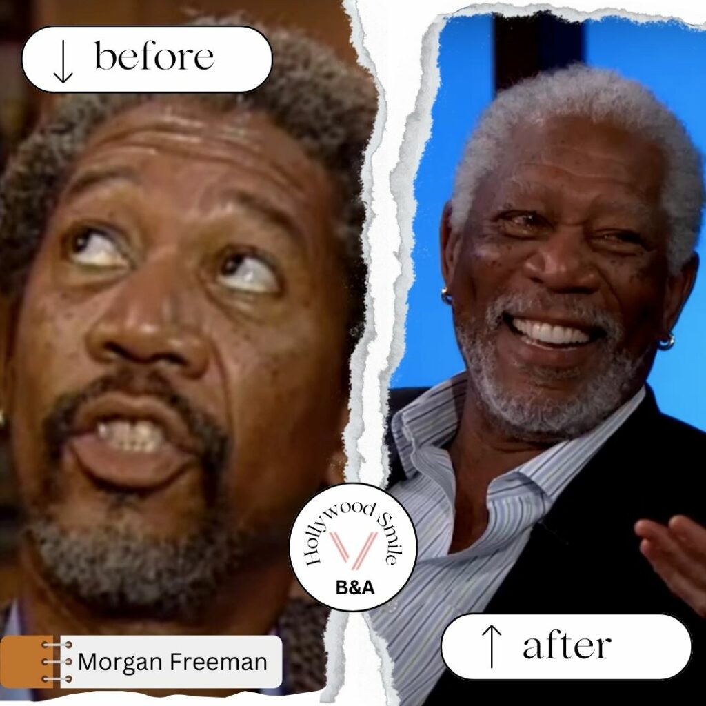 Morgan Freeman Smile Makeovers (Hollywood Smile) Before After