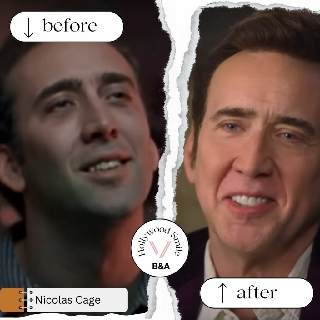 Nicolas Cage’s Smile Make Overs (Hollywood Smile) Before and After