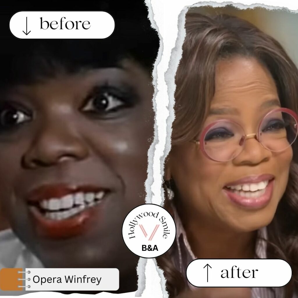 Oprah Winfrey Smile Makeovers (Hollywood Smile) Before After