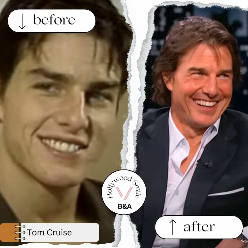 Tom Cruise Smile Makeovers Hollywood Smile Before After