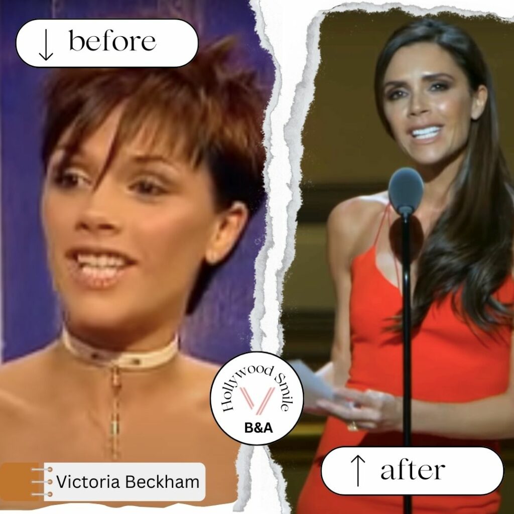 Victoria Beckham Smile Makeovers Hollywood Smile Before After
