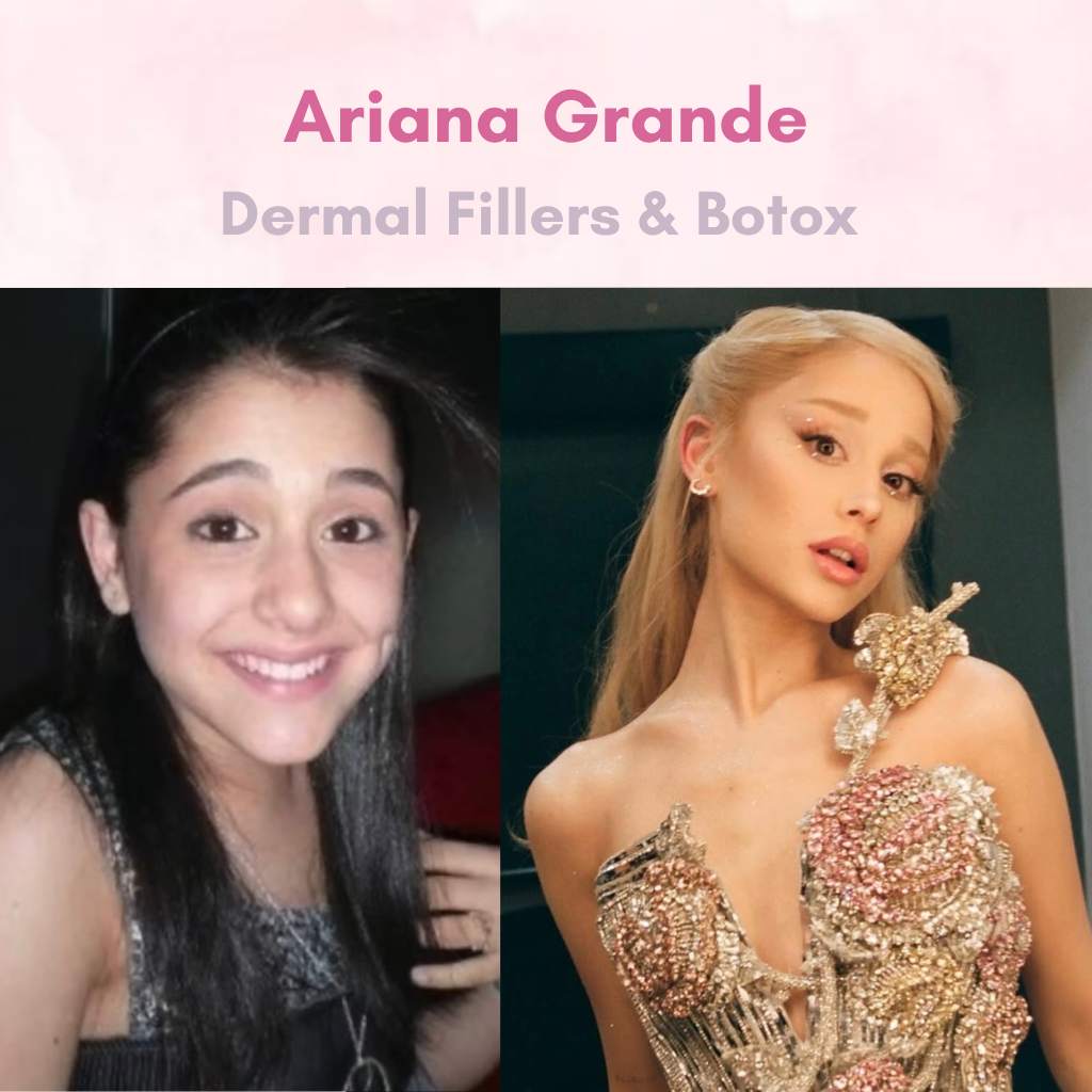 Ariana Grande - Celebrity Botox & Fillers