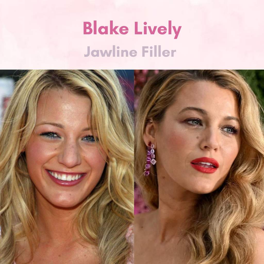 Celebrity Botox & Filler - Blake Lively