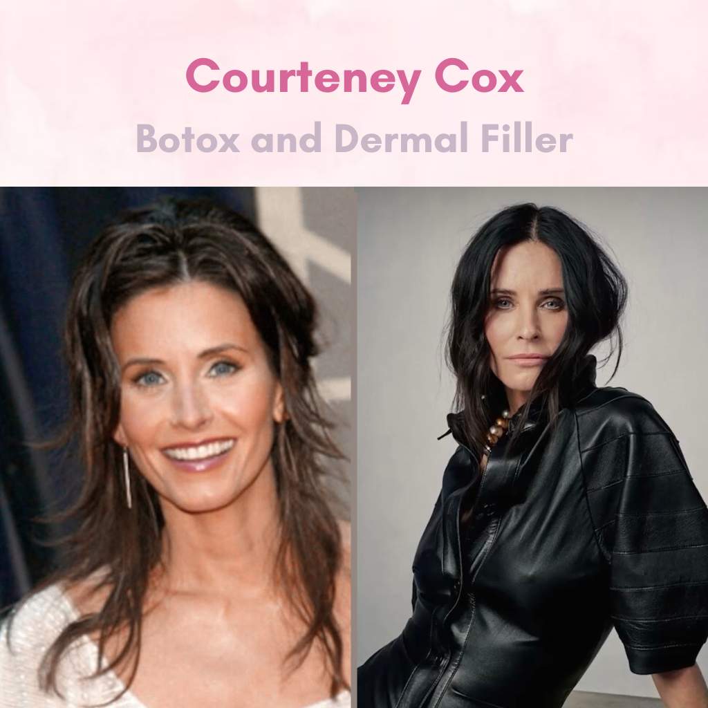 Celebrity Botox & Filler - Courteney Cox
