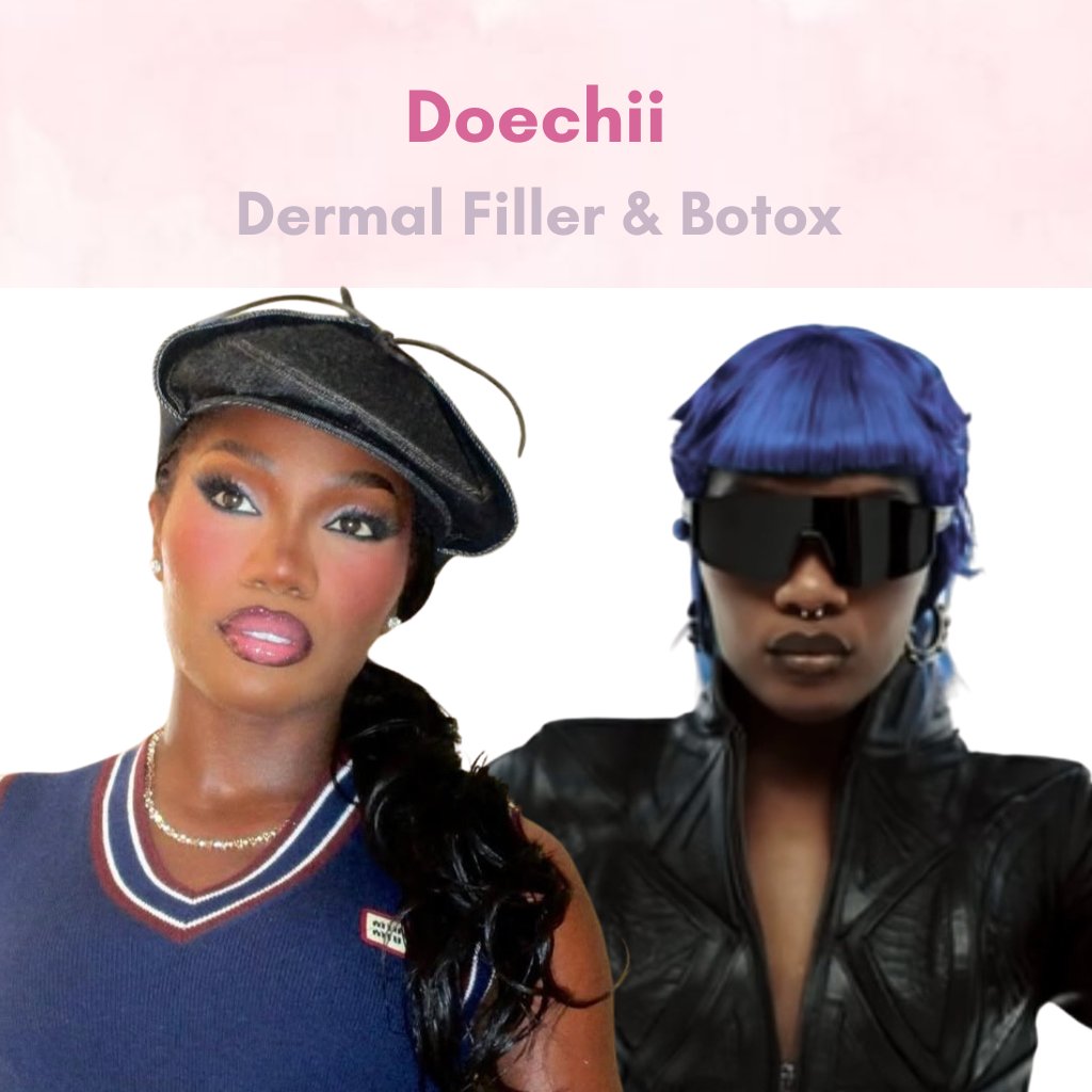 Doechii - Celebrity Botox & Filler Before After