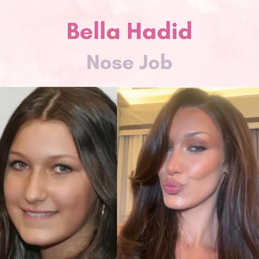 bella hadid before rhinoplasty