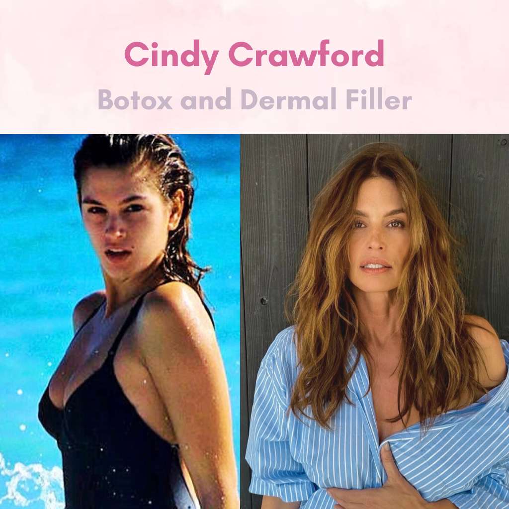 cindy crawford - celebrity botox & filler favorites
