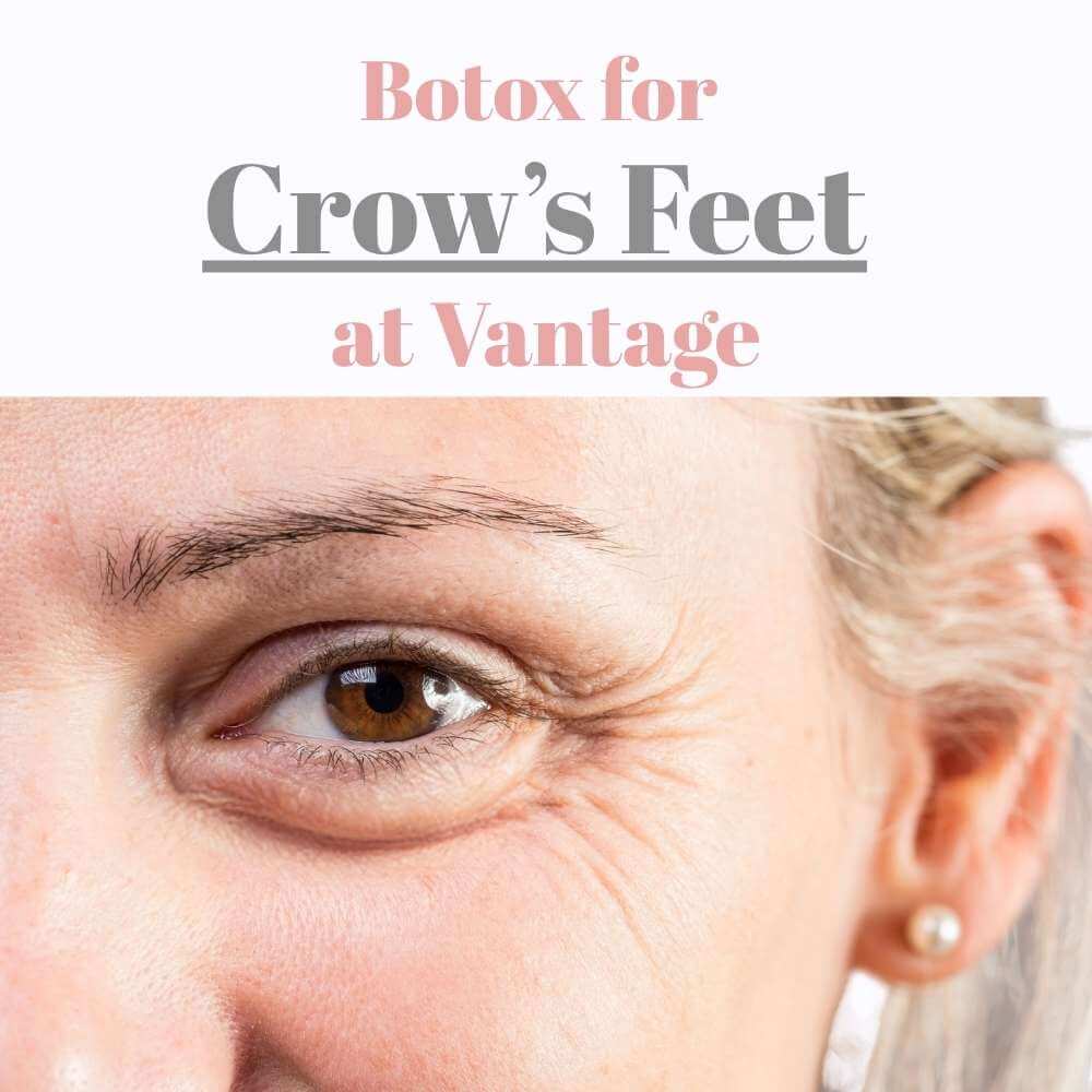 botox for crow's feet at vantage